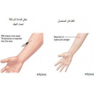 فحص الجلد من الدرن